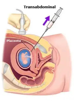 Chorionic Villous Sampling (CVS)